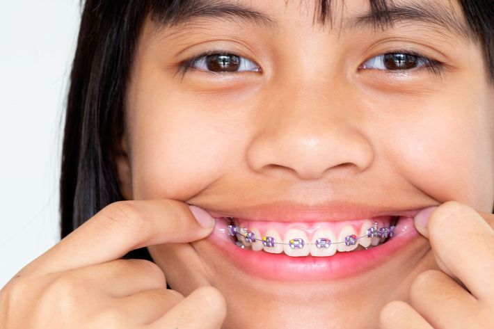 A young girl with braces on her teeth is smiling.