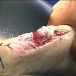 A close-up view of an open, deep wound on human skin, showing underlying tissue and muscle.