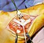 A surgical incision in human tissue with a retractor holding the area open and a long, thin ligament visible.