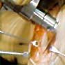 Close-up of a surgical procedure showing metallic instruments interacting with biological tissue.