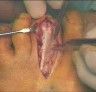 Surgical view of a toe incision, showing a deep cut with exposed tissue being held apart by metal instruments.