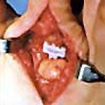 Surgical view of a spinal disc space with a rectangular, serrated medical implant placed between vertebrae.