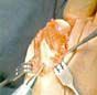 A close-up of a surgical procedure showing metallic instruments retracting soft tissue to expose a bone structure.