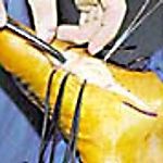 Medical procedure showing surgical instruments operating on a yellow-toned anatomical area, likely a limb.
