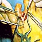 A surgical illustration showing medical instruments holding tissue during an appendectomy procedure.