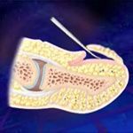 A cross-section illustration of a human fingertip showing a thin, sharp instrument lifting a fingernail away from the skin.