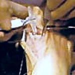 A surgical view showing an incision being made on tissue with medical instruments in a sterile, clinical setting.