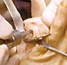 Surgical instruments held by gloved hands operate on exposed tissue in a clinical setting.
