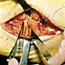 A surgical procedure showing a metal retractor holding open a deep, fleshy incision in human tissue.