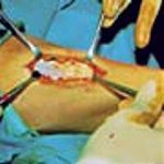 Surgical procedure with retractors held in place to expose a wound on the skin, set against a blue surgical drape.
