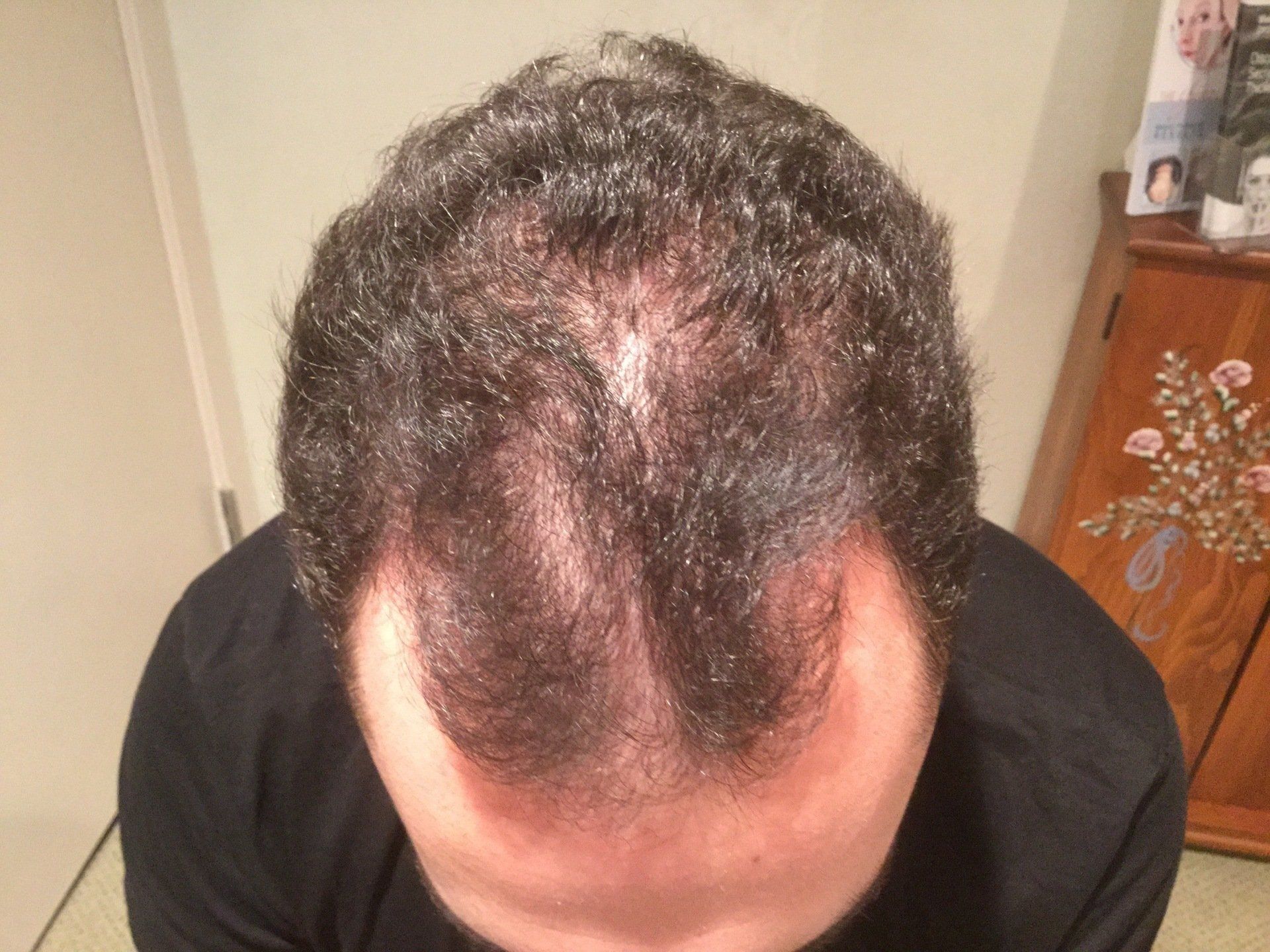 Medical Management Restores Global Hair Loss