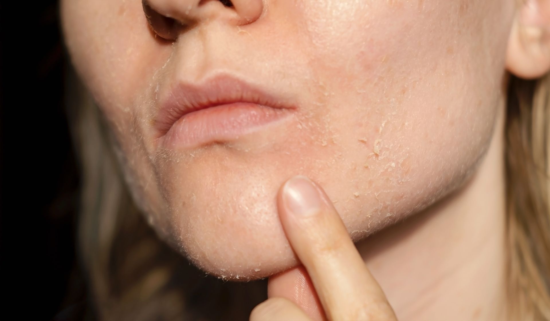 Woman pointing at dry, flaky skin on her chin and face.
