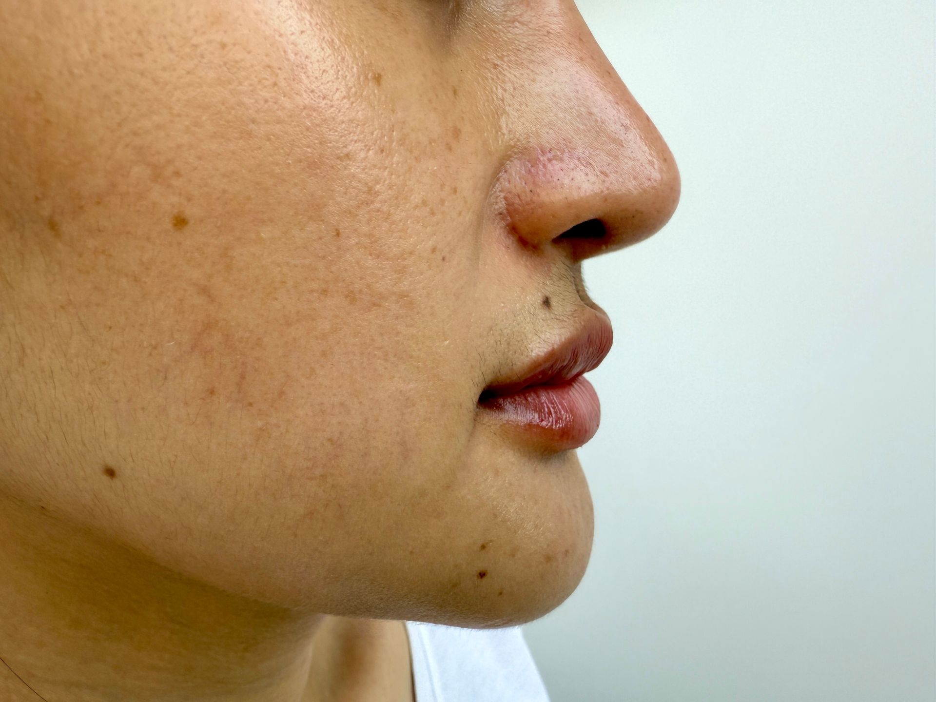 Profile view of a person's face with light skin, visible pores, and dark spots.