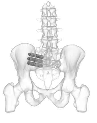 SI Solutions | Innovative Solution for SI Joint Pain