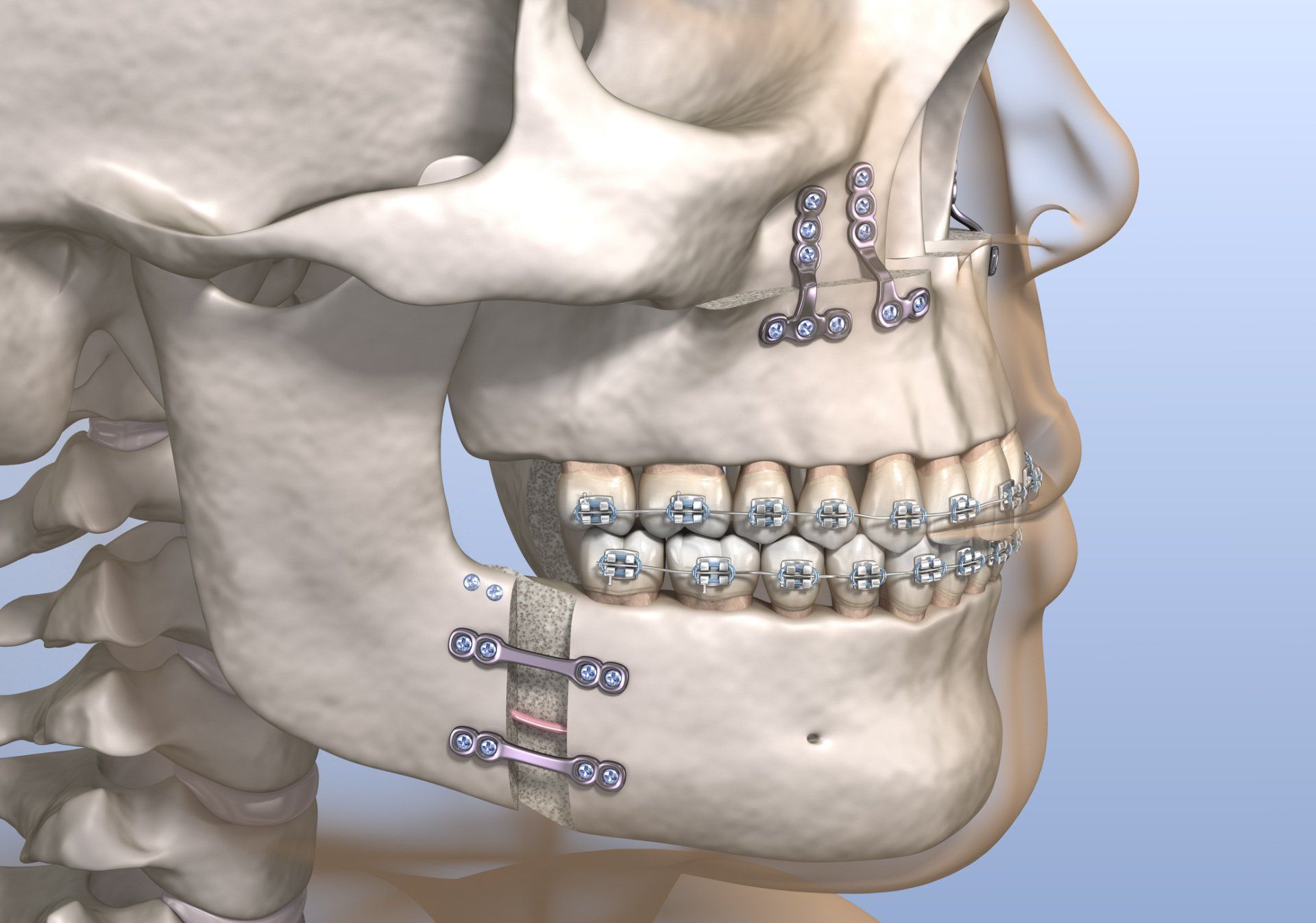 Jaw surgery illustration — Jackson, MS — Central MS OMS