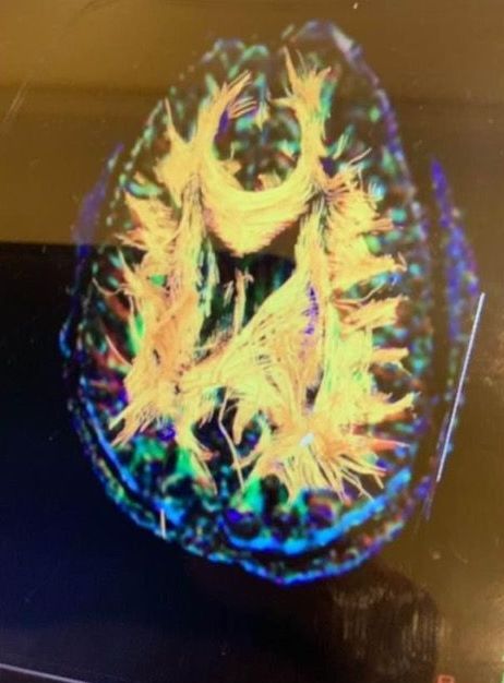 A cell phone screen shows a picture of a brain.