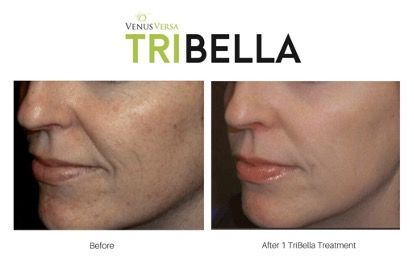 A woman 's face is shown before and after a tribella treatment