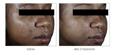 A before and after photo of a woman 's face.