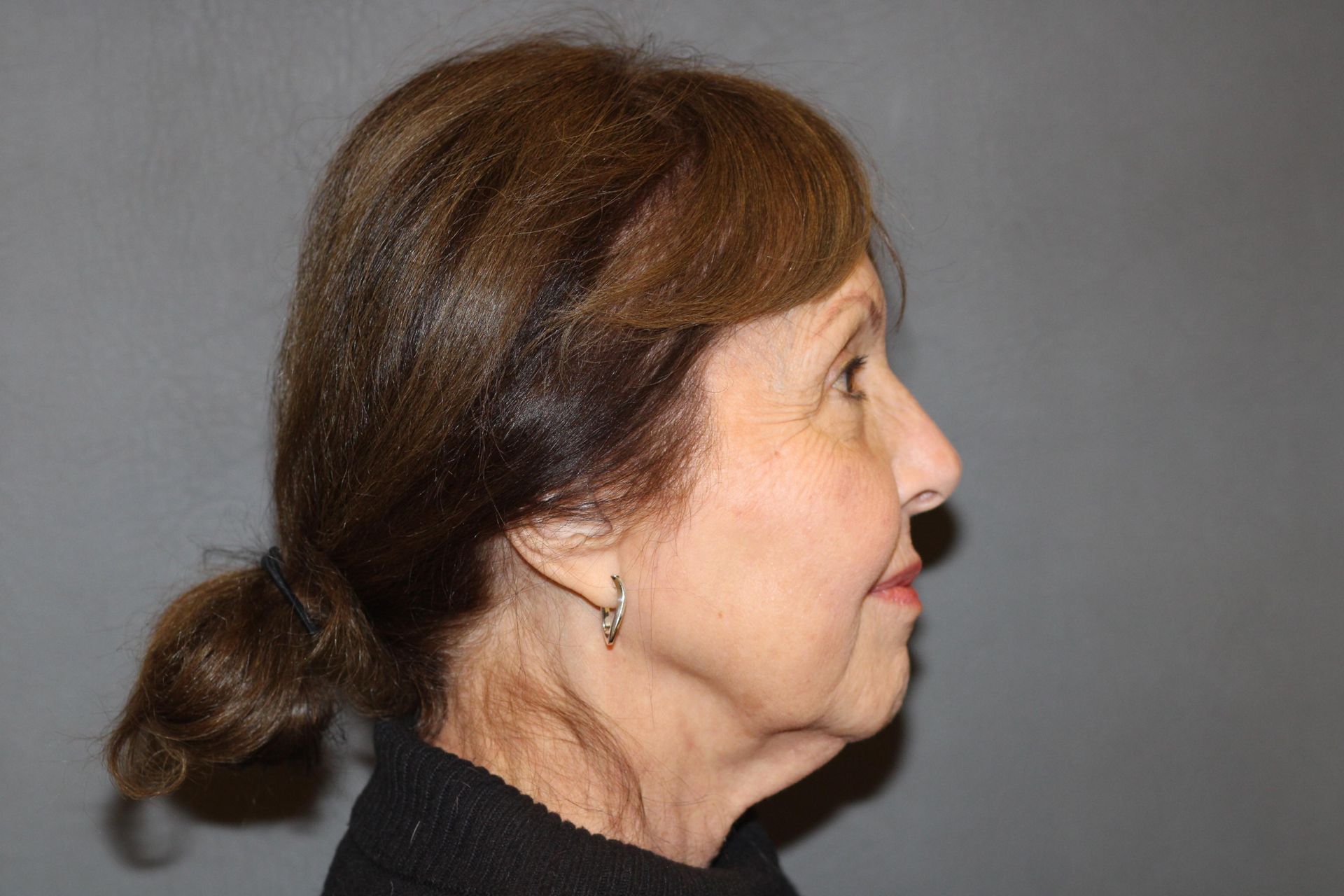 Facelift