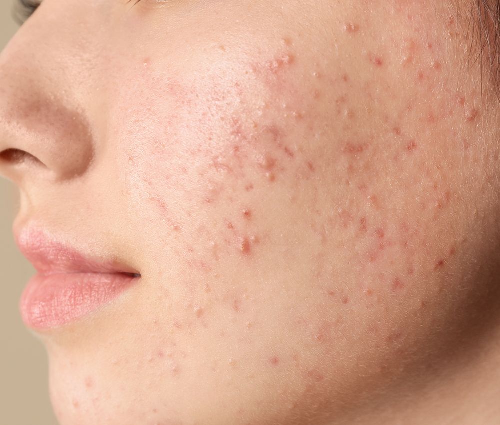 Person Face With Acne