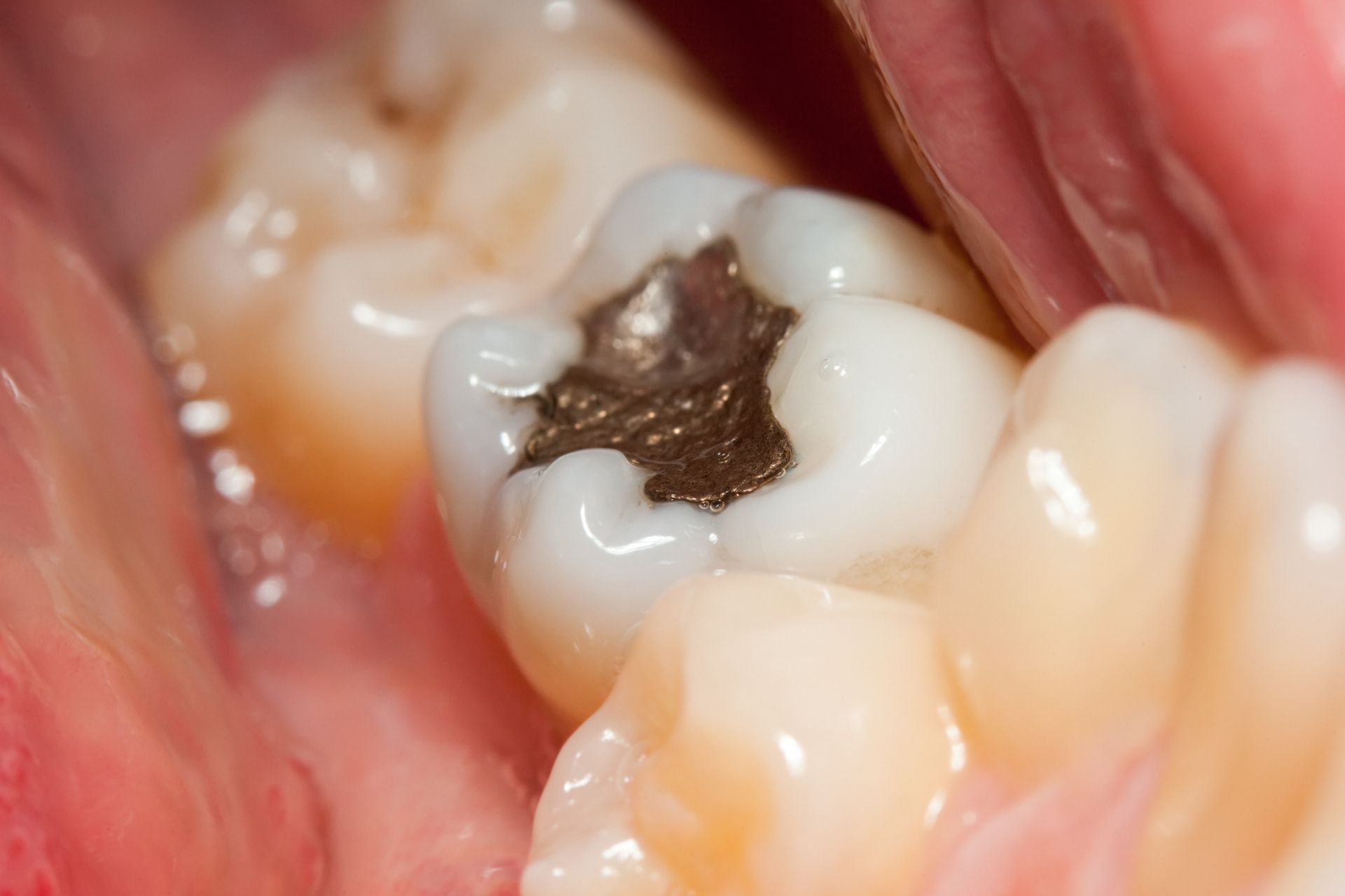 Close up of filling in tooth