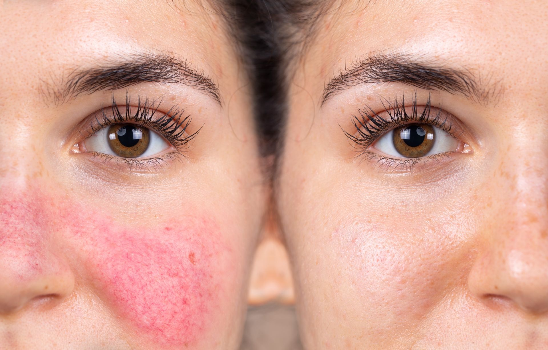 A before and after photo of a woman 's face with red spots.