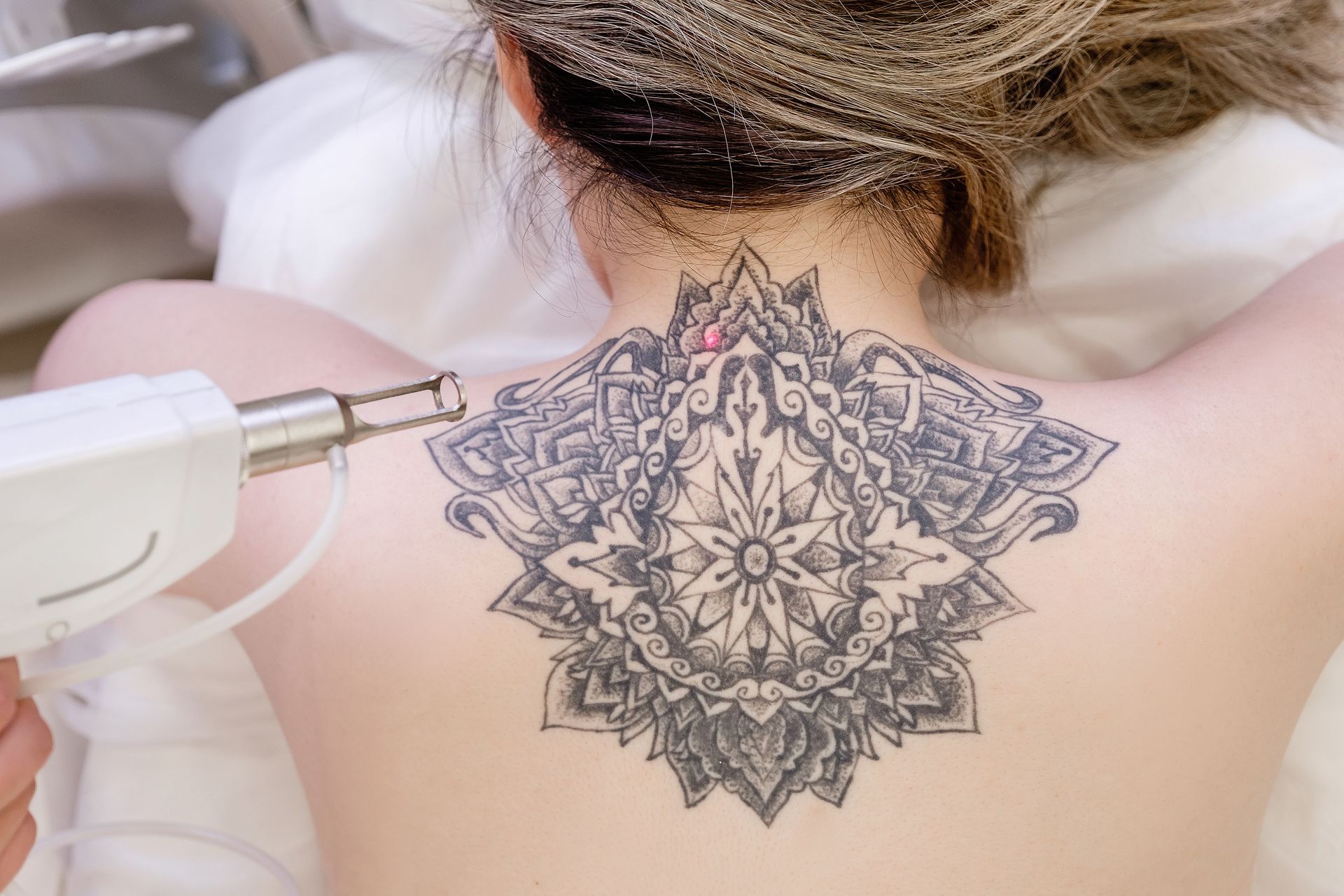 A woman is getting a tattoo removed from her back.