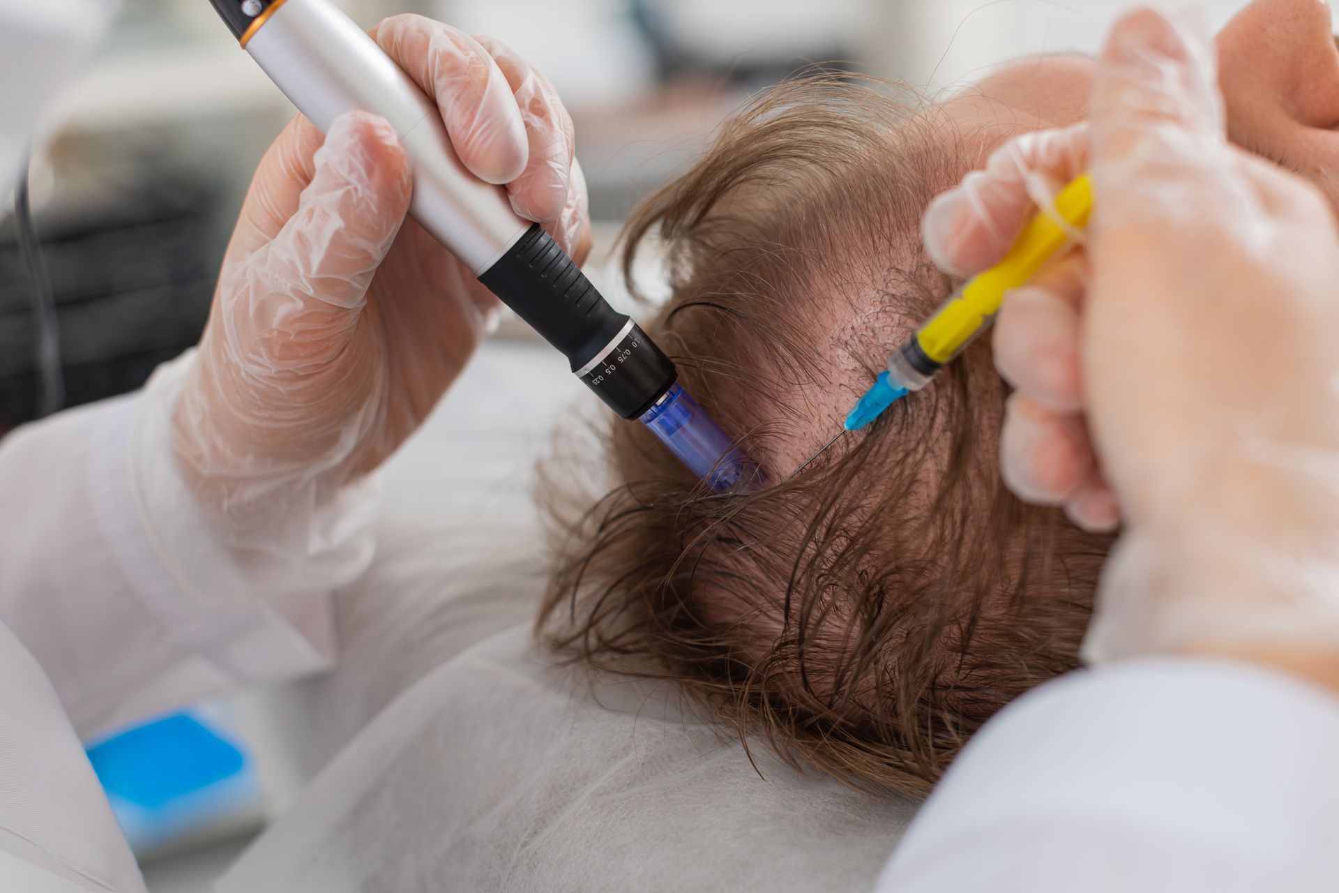 Person receiving scalp treatment with a microneedling device and syringe.