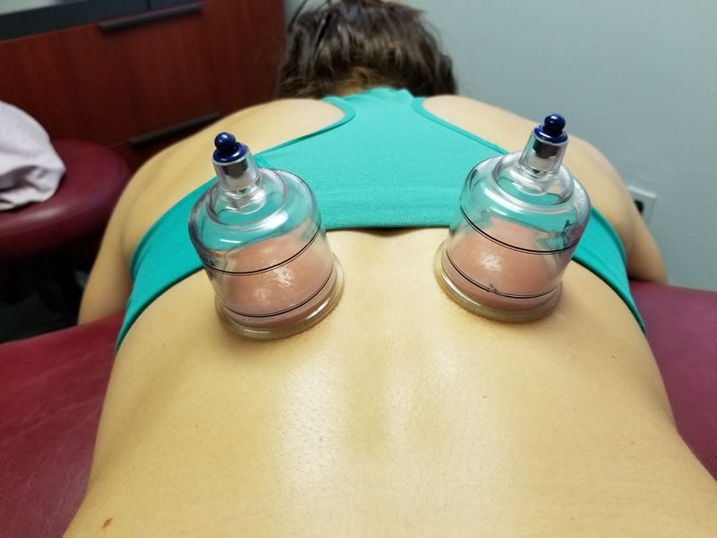 Person receiving cupping therapy on their back with red marks from the suction cups.