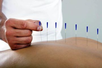 Person receiving acupuncture needles in their back.