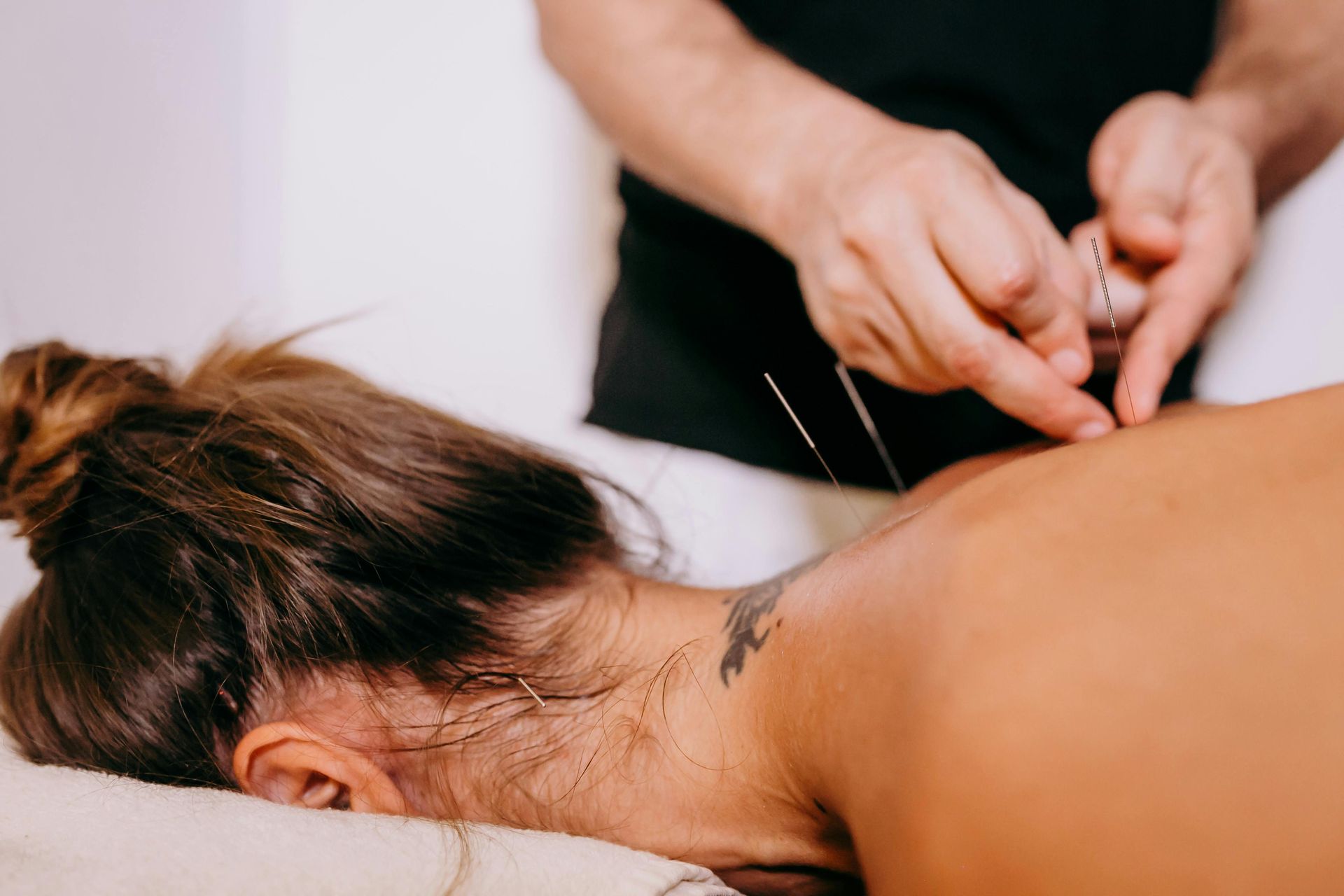 Acupuncturist placing needles in a woman’s upper back during a massage treatment