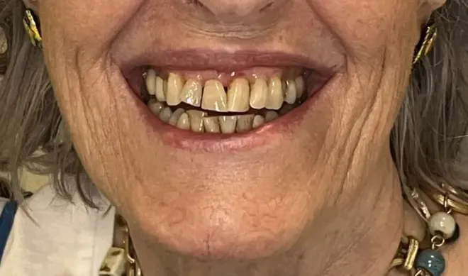 Close-up of a smiling person's mouth, showing worn and discolored teeth and wrinkles around the mouth.
