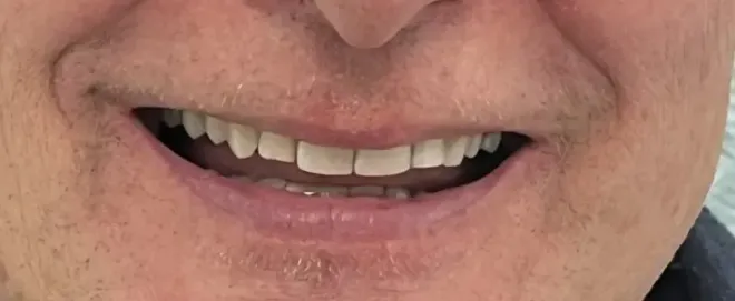 Close-up of a person's smiling mouth showing straight, white teeth. Skin is visible.