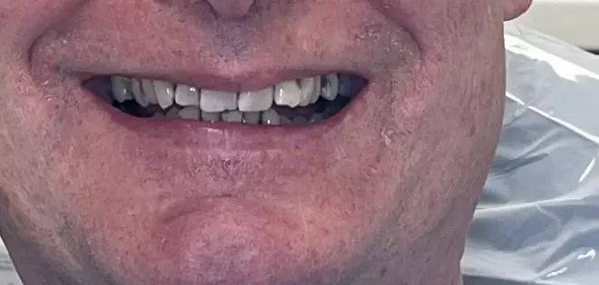 Close-up of a person's mouth with visible teeth. The person is smiling, showing the upper teeth with some gaps.