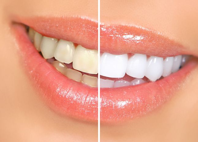 A close-up comparison of teeth before and after whitening. One side is yellow, the other bright white.