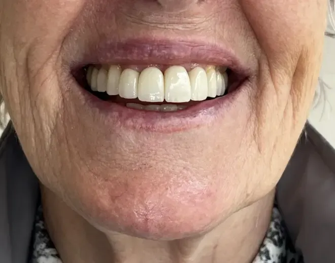 Close-up of a person's smiling mouth showing a full set of bright white, well-aligned teeth.