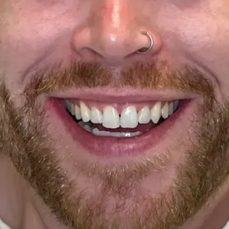 Close-up of a smiling person with a brown beard and nose ring, showing white teeth.
