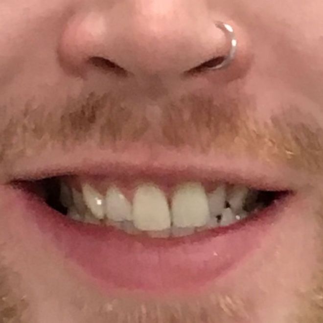 Close-up of a person's smiling mouth, visible teeth, and nose with a silver nose ring.