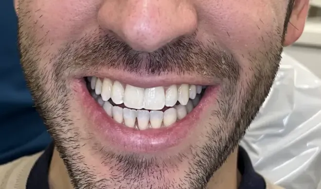 Close-up of a smiling person's teeth. They are white and evenly spaced. Brown stubble.