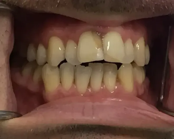 Mouth with teeth showing discoloration and a chipped front tooth; gums visible.