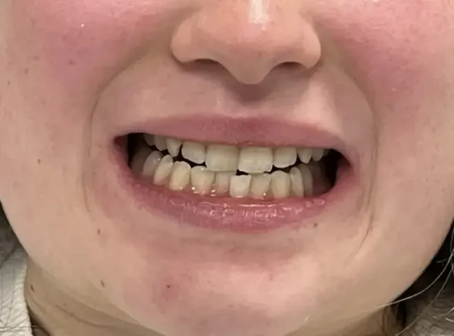 Close-up of a person's mouth showing teeth. 