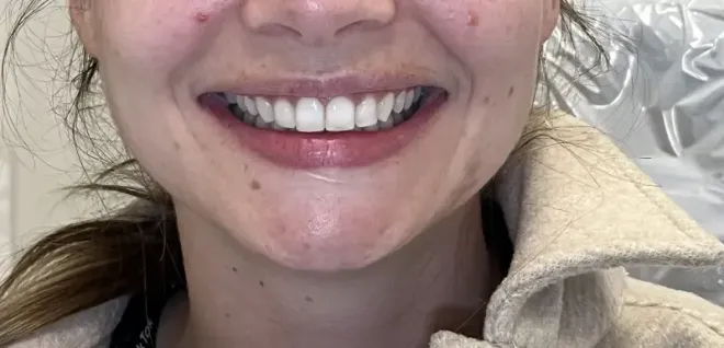 Close-up of a smiling person's mouth, showing bright white teeth, pink lips, and a cream-colored jacket.