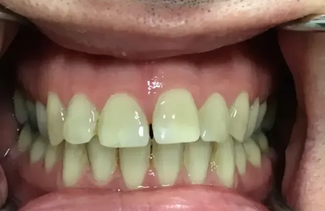 Close-up of a person's teeth. Upper and lower teeth are visible, with a small gap between the front teeth.