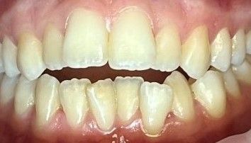Close-up of human teeth, showing a slight overbite and some yellowing.