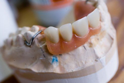 protesi dentale totale