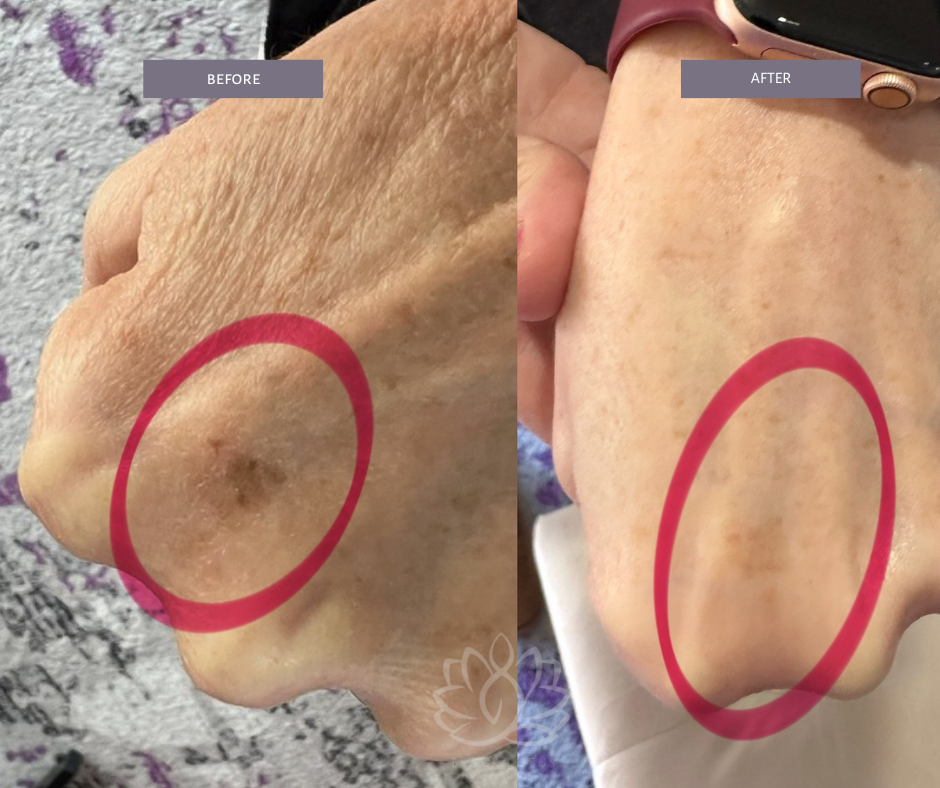 A before and after photo of a person 's hand