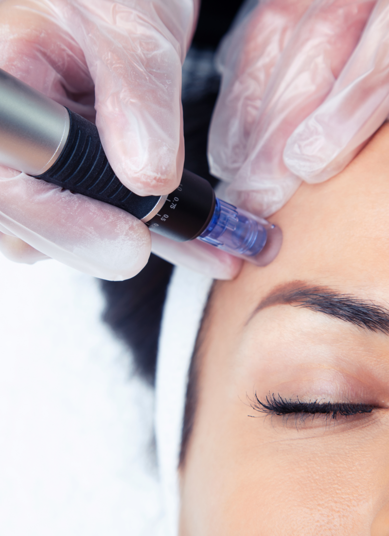 A woman is getting a microneedle treatment on her forehead.