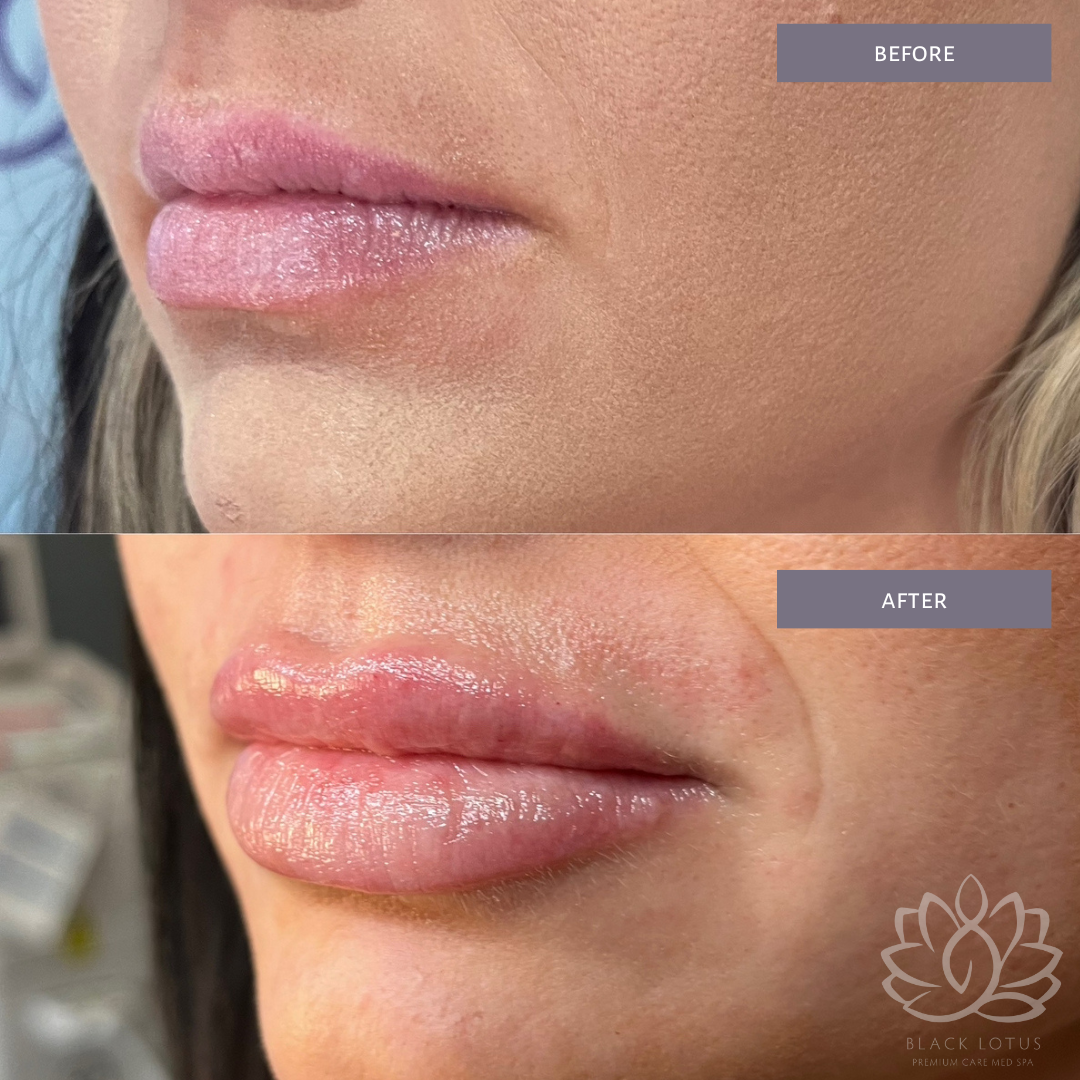 A before and after photo of a woman 's lips.