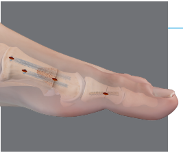 Ankle Fractures - Bunbury Foot & Ankle Surgeon