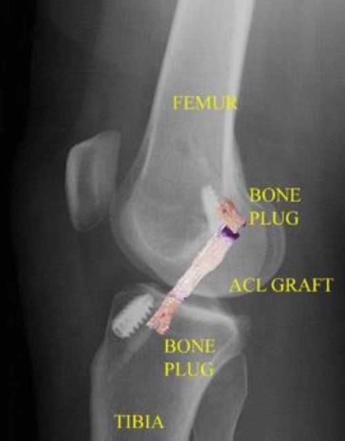 Ankle Sprain or Ligament Injury - Bunbury Foot & Ankle Surgeon